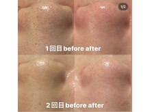 ハイコガオ(HIKOGAO)/部分ハイドラ＋プラズマ2回施術