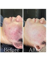 デン(DEN)/ニキビ改善ケア