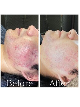 デン(DEN)/ニキビ改善ケア