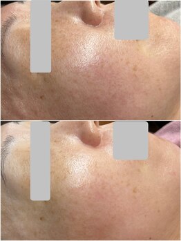 ティアーナ(Tiaana)/ララピール２回施術後