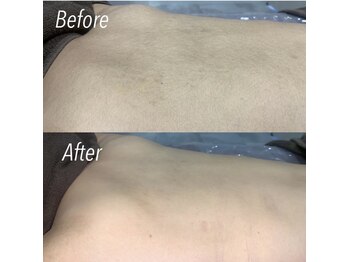 ハイリー(Hily)/背中 before、after