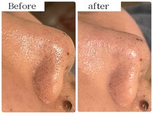 ソナミオール(SonaMior)/黒ずみは皮脂の酸化です！