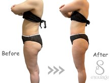 エスラージュ(esoulage)の雰囲気（《リバウンド無し★話題の脂肪冷却》お腹¥8900/太もも¥13000）