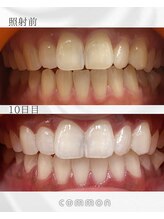 セルフホワイトニングコモン 藤枝店(self whitening common)/10日間ベーシックコース