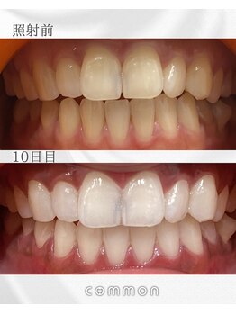 セルフホワイトニングコモン 藤枝店(self whitening common)/10日間ベーシックコース
