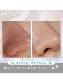 エメ(Aimer)の写真/【毛穴洗浄】黒ずみ・開き・ざらつきを徹底ケア◎つるんと毛穴レスな素肌へ