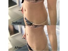 ブレスト 新宿本店(Breast)/《6回目》30代　（痩身）