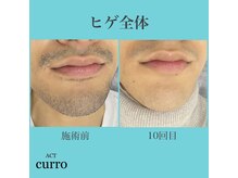 アクト クロ(ACT curro)/【ヒゲ全体】脱毛施術例
