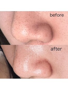 イルマーレ(Il Mare)/毛穴洗浄コース