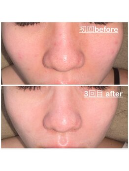 ミニョン(mignon)/ニキビが出来づらくなります！