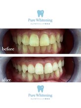 ピュアホワイトニング 横浜店/ホワイトニング横浜