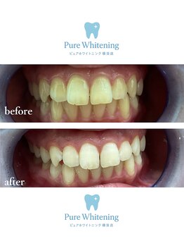 ピュアホワイトニング 横浜店/ホワイトニング横浜