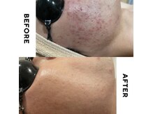 トータルスキンケア 美容ルーム(美容Room)の雰囲気（ニキビケアピーリングでここまでキレイに☆）