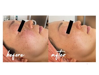 private salon Soame/透明感UP★ホワイトスノーピール