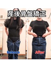 さらさ整骨院/産後骨盤矯正ビフォー・アフター