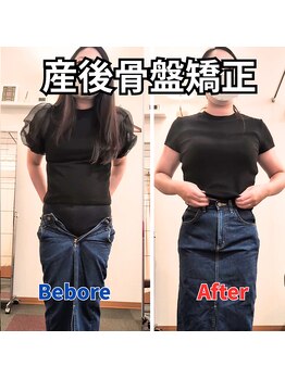 さらさ整骨院/産後骨盤矯正ビフォー・アフター