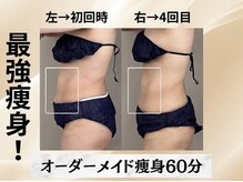 イヨヨ(iyoyo)/BeforeAfter　施術４回
