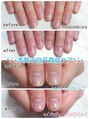 ノーブルフルール(Noble fleur)&nbsp;自爪育成/自信の持てる自爪へ/深爪/爪の形が気になる/爪が弱い