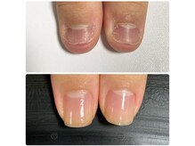 ルカロンネイル(Rukaron Nail)/噛み爪・むしり爪