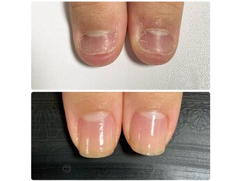 ルカロンネイル(Rukaron Nail)/噛み爪・むしり爪