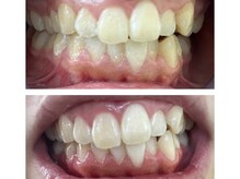 エクシアホワイトニング 郡山店/ホワイトニングビフォーアフター