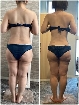 ハレアンド(Hare&)/40代全身痩身15回目Before After