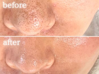 メモリ/お客様の変化/毛穴ケア