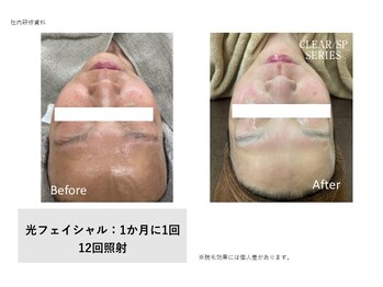 イル 名取店(iru)/光フェイシャル
