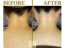 ヴェールブランシュ 町田(Vert Blanche)/#ブライダルエステ#シェービング