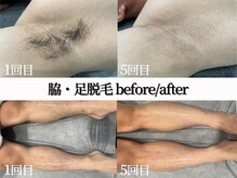 シャイン 蒲田店(SHINE)/脇・足のビフォーアフター