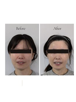 ミヤビ(miyabi)/ルネセルスキンケア体験