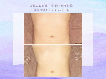 サロン タエン/15分でくびれ！腹部インディバ