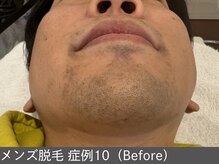 オアシスラグーン(OASIS LAGOON)/メンズ脱毛（症例10 before）