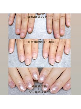 ネイルジョブ(NAIL JOB)の写真/《深爪矯正得意サロン認定◎》ご希望の長さ形フォルムに拘り抜いた施術◎/ジェルでの自爪育成も対応◎