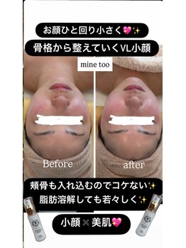 マイントゥー(mine too)/VL小顔★小顔もマッサージ
