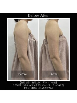 ブラン(Blanc)/ブライダルエステ