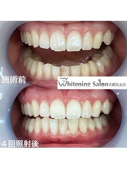 ホワイトニングサロン 京都烏丸店/ホワイトニング施術例