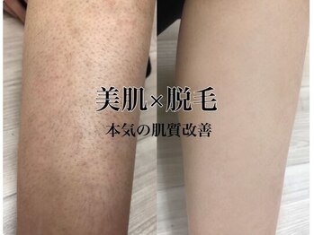 アルゴ 伊勢崎店(ALGO)/ 脱毛しながら美肌へ!!
