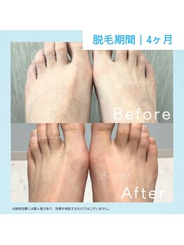 メンズクリア スマーク伊勢崎店/【メンズクリア】お客様の施術例