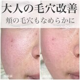 ルネッタ(Lunetta)