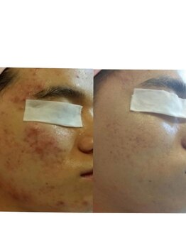 アール(R)/韓国エステ肌管理コース