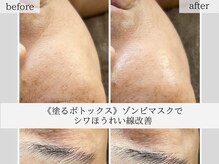 ポノーラ(Ponola)の雰囲気(針を使わない天然BOTXフェイシャルとして人気)