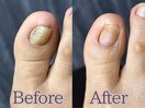 【二枚爪】フットケア大阪