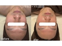 ルルアス(LuLu AS)/シリカニードル２回目