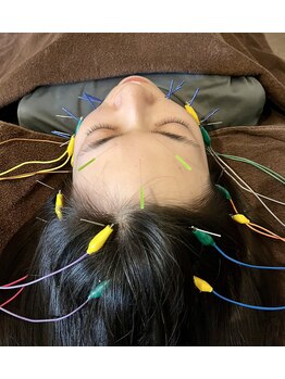 ナチル(Nachill)/美容鍼