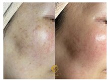 しらゆき 名古屋黒川/シミケア