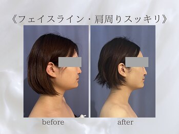 ジュプン 長崎/小顔筋膜のお客様★