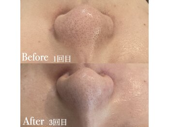 ボディヒーリングアンド小顔美容矯正 プララン/毛穴ビフォーアフター