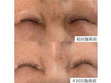 ルポ(RUPO)/シミ・しわ・くすみ（60代）