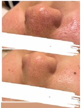 フォトビズ/ハイドロ毛穴洗浄＆フォト組合術